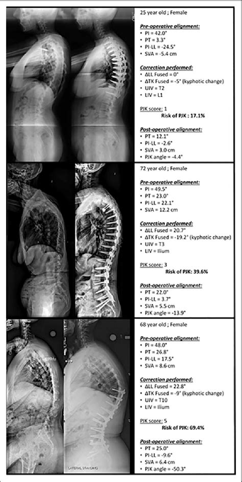 Example Of Patients With Pjk Proximal Junctional Kyphosis Scores