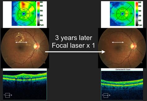 Clinically Significant Macular Edema Oct