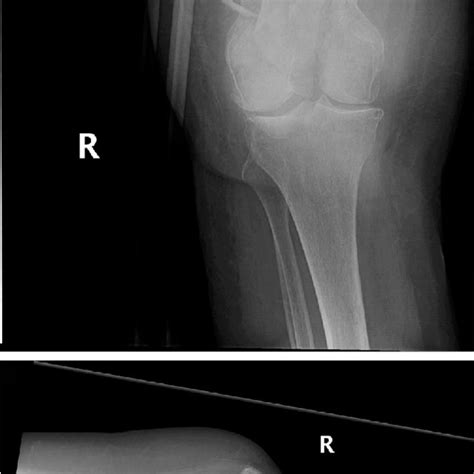 Anteroposterior And Lateral Radiograph Of The Left Knee After Operation Download Scientific