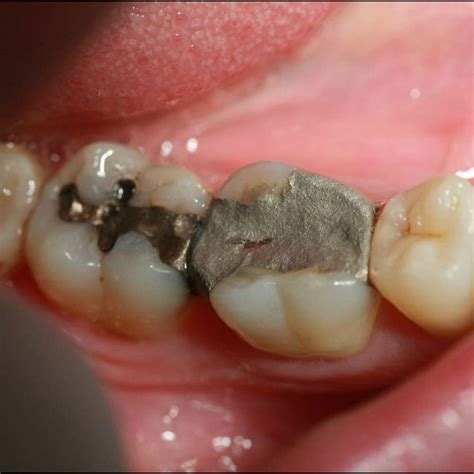 The First Dental Amalgam Mercury Filling Was Used In England And France