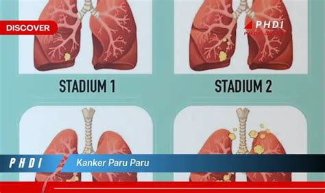 Ketahui Gejala Kanker Paru Paru Yang Wajib Kamu Intip