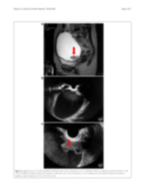 Solution A Case Of Ovarian Adenosquamous Carcinoma Arising From