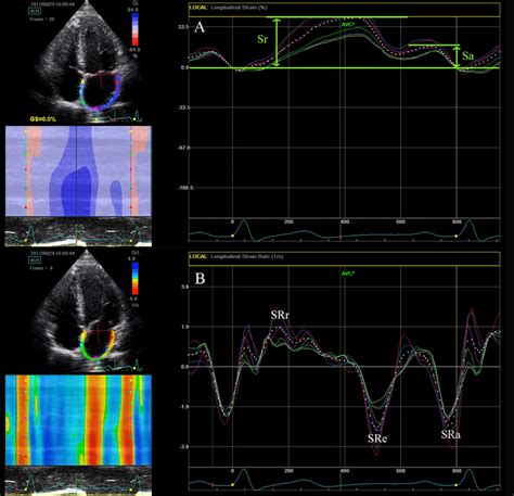 Speckle Tracking Echocardiographic Left Atrial Strain Waves A Left Download Scientific Diagram