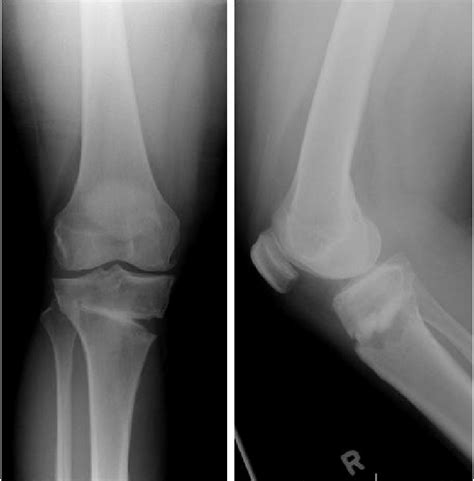 AP And Lateral Radiographs Taken 6 Months Post Op After High Tibial