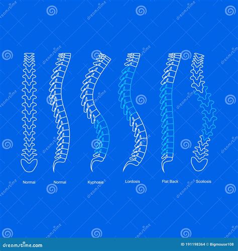 Types Of Scoliosis. C, S, Z Shaped Scoliosis. Dextroscoliosis
