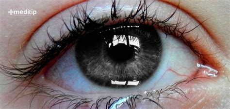 Causas de los ojos llorosos y lágrimas excesivas Meditip