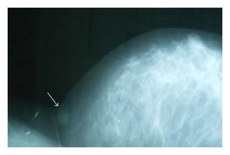 Mass in the axillary tail of the left breast (mammographic image ...