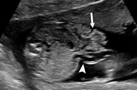 An Algorithmic Approach To Complex Fetal Abdominal Wall Defects AJR