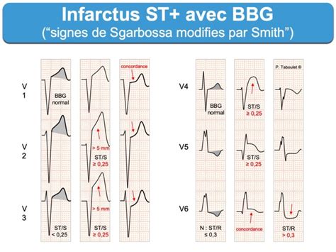 Infarctus 5c BBG E Cardiogram