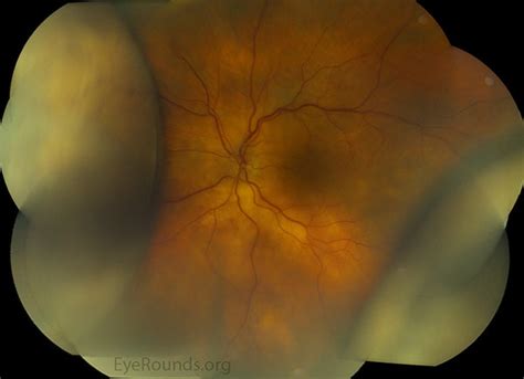 Choroidal Effusion In Posterior Scleritis