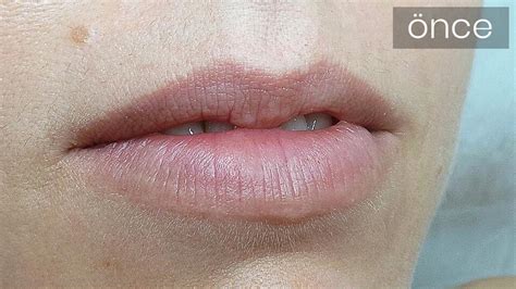 Permanent Lip Color Tattoo In Istanbul Turkey