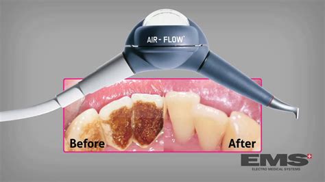 Ems Airflow Griffith Dental Lounge