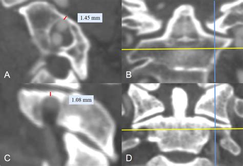 Ideal Entry Point And Trajectory For C Pedicle Screw Placement In