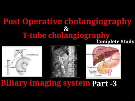 T-tube cholangiography / Post operative cholangiography ## Biliary ...