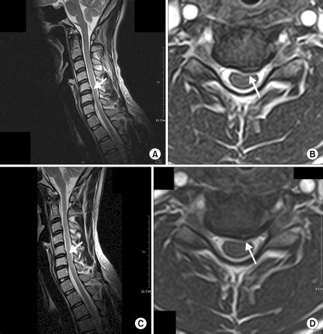 Pre And Post Nucleoplasty Magnetic Resonance Imaging For A Year Old