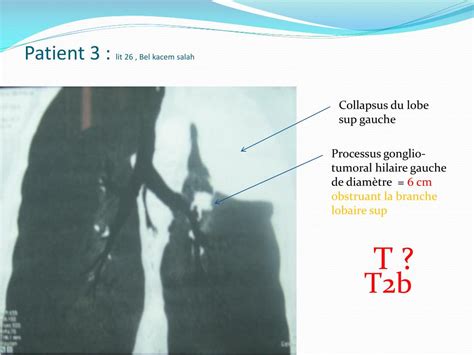 Ppt Imagerie Du Cancer Bronchique And Classification Tnm Powerpoint