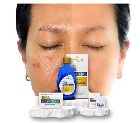 Tira Manchas Natyflora Antes E Depois - Kit Tira Manchas da Pele, Sabonete, Sabonete Líquido e Pomada ...