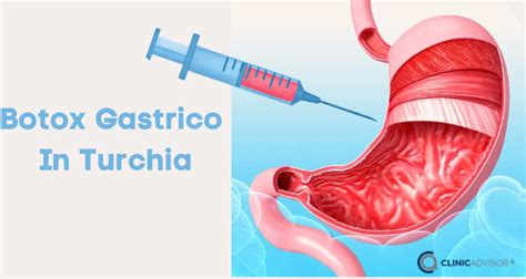 Botox Gastrico In Turchia Chirurgia Estetica Servizi Medici In