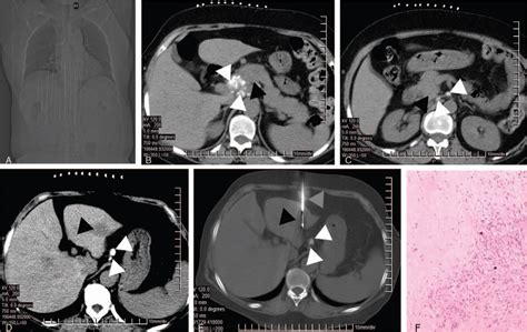 Calcified Peripancreatic Lymph Nodes In Pancreatic And Hepat Medicine