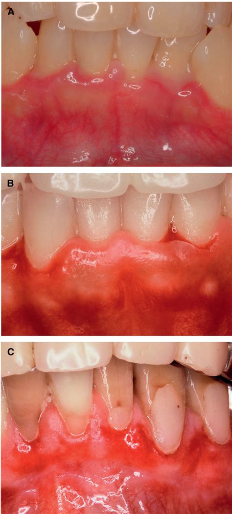 A Stab And Roll Biopsy Technique To Maintain Gingival Epithelium For