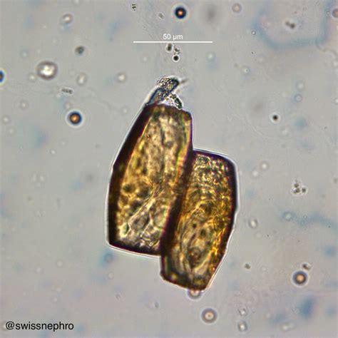 Uric Acid Crystals In Urine