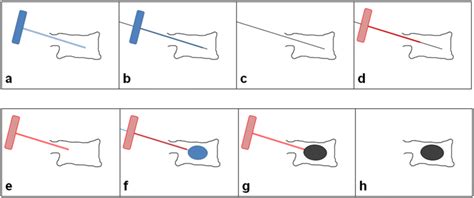 Steps Of A Kyphoplasty Procedure Using The Standard Vertebra Access Download Scientific Diagram