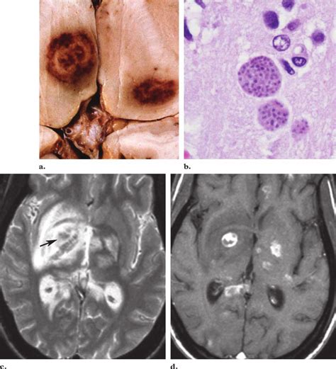 Toxoplasmosis In A 28 Year Old Man With Hiv Infection A Photograph