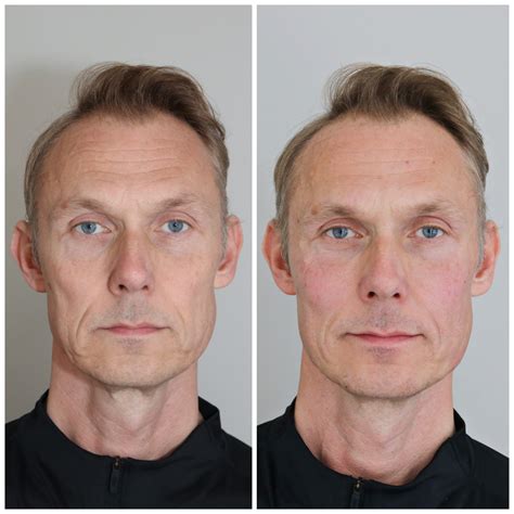 Facelift Man Svenska Hudkliniker