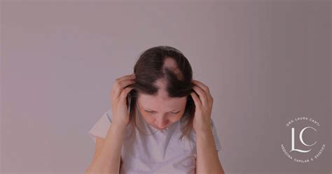 Falhas no cabelo o que é alopecia areata Veja causas e tratamento