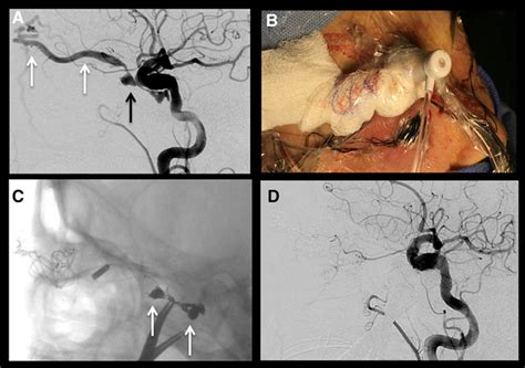 Carotid Cavernous Fistula Stroke