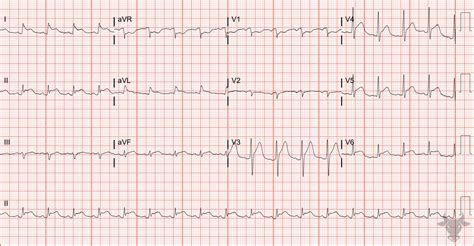 Acute Pericarditis Ecg Stampede