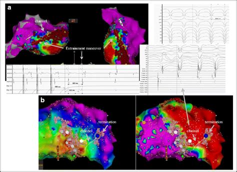 A B Two Carto Guided Electroanatomic Maps Eam Of The Left