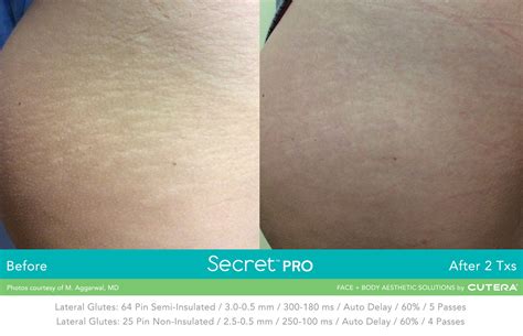 Discover The New Secret Pro Co2 Skin Laser Cutera 2023