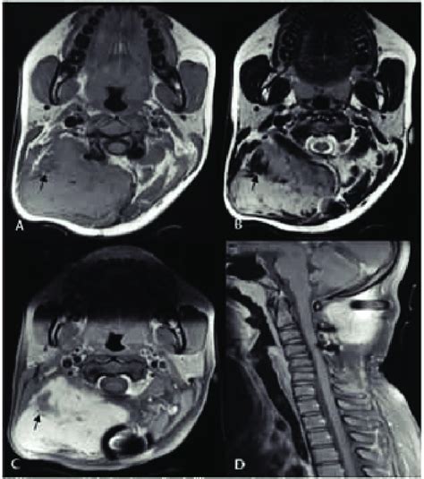 A D Contrast Enhanced Magnetic Resonance Imaging After 9 Months