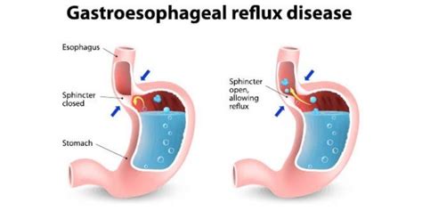 Kenali Perbedaan Gerd Dan Maag Si Penyakit Sejuta Umat Binustv