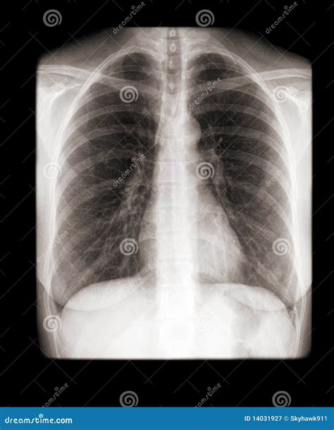 X Ray Of A Human Chest Front View Stock Image Image Of Anatomy Exam