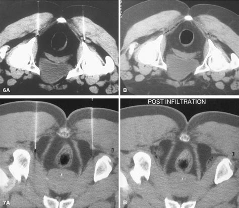 Pudendal Nerve Block Procedure