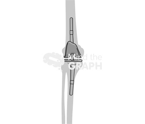 Total Knee Arthroplasty Revision Approach Bone