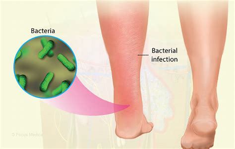 Health Condition : Symptoms, Causes, Treatment and More