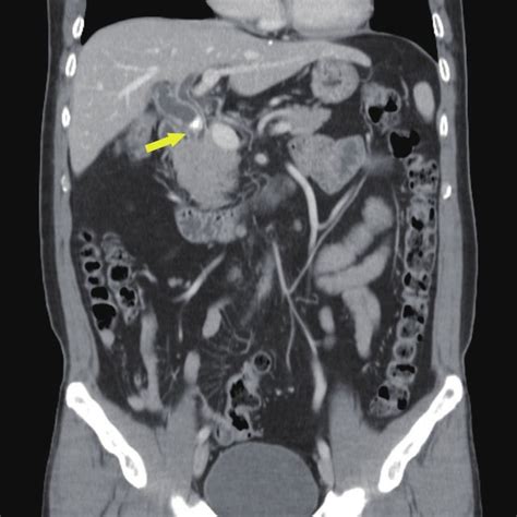 Ercp Revealing A Stone In The Cystic Duct Marked With Arrow Download Scientific Diagram