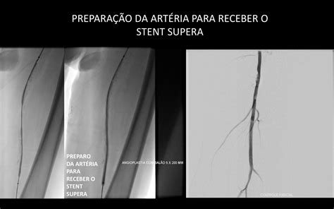 Abordagens Endovascular Na DoenÇa Arterial PerifÉricanovembro 2019