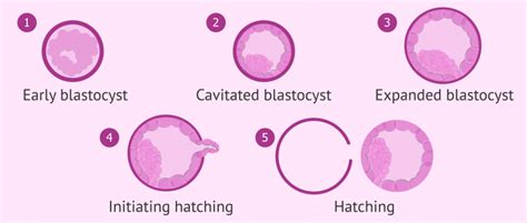 Grades of expansion of a blastocyst