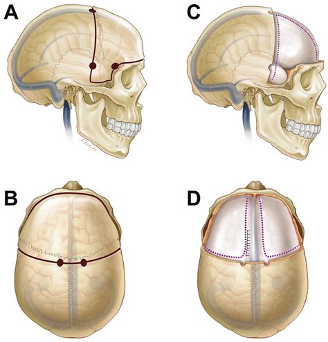 Illustration Depicting Bifrontal Dc A And B The Solid Line And Bur Download Scientific