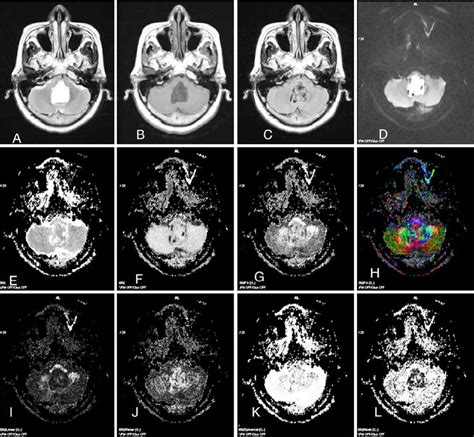 Case 9 Fourth Ventricular Epidermoid Cyst Which Appears Hyperintense