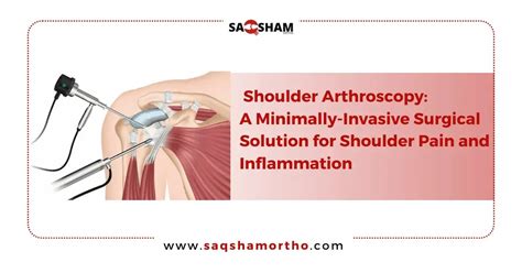 Shoulder Arthroscopy A Minimally Invasive Surgical Solution For