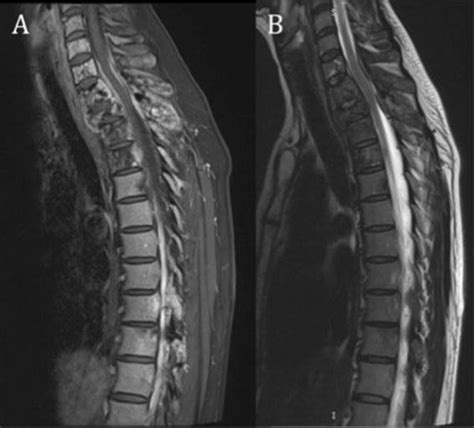 Pre Operative Sagittal T1 A And T2 B Mri Sequences Download Scientific Diagram