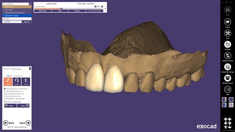 Exocad Exoplan Implant Solutions Direct