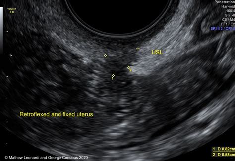 Noninvasive ultrasound diagnosis of endometriosis | Contemporary OB/GYN