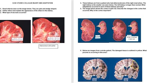 Pale Infarct Kidney