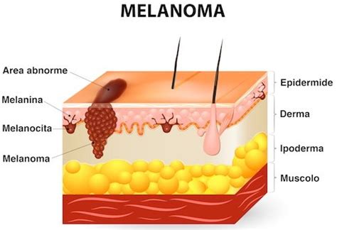 Oncologi Esperti In Melanoma E Tumori Della Pelle Consulto Online